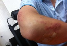 How Burn Injury Attorneys Can Help You Get Fair Compensation After an Accident Burn Injury Attorneys