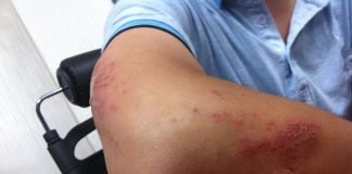 How Burn Injury Attorneys Can Help You Get Fair Compensation After an Accident Burn Injury Attorneys