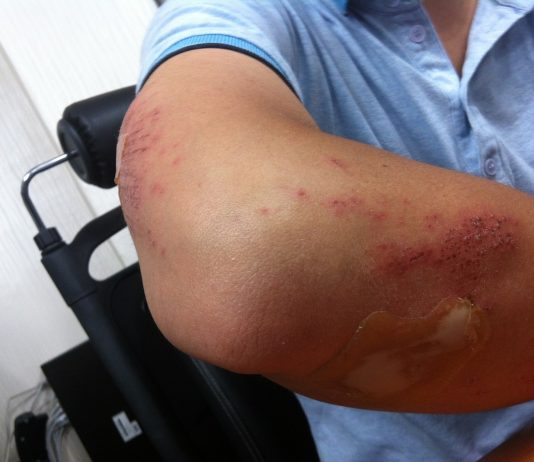 How Burn Injury Attorneys Can Help You Get Fair Compensation After an Accident Burn Injury Attorneys