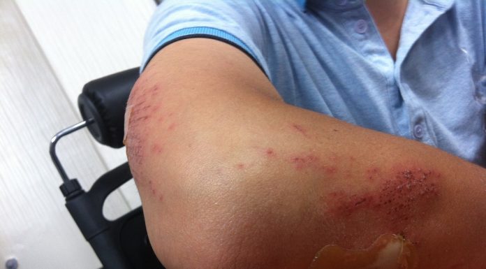 How Burn Injury Attorneys Can Help You Get Fair Compensation After an Accident Burn Injury Attorneys